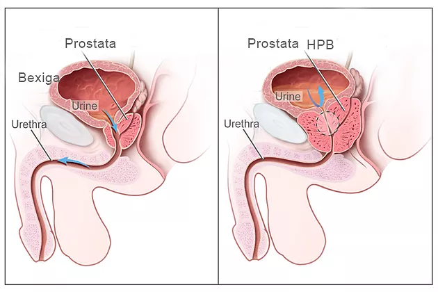 prostatitis a harmadik napon